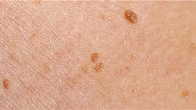 5 مرات.. النساء المصابات بفيروس الورم الحليمي أكثر عرضة للسكتة الدماغية| دراسة 