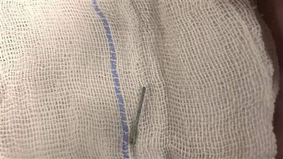 اخترق عظمة القص.. استخراج دبوس تنجيد من صدر شاب في بنها