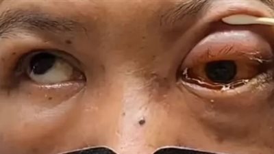 رجل أربعيني يُصاب بالعمى الجزئي بعد تناوله أدوية الأرق ونومه على وجهه