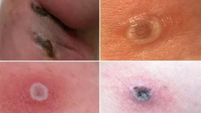 عدوى فطرية قاتلة تشبه جدري القرود.. تعرف على أعراض فيروس ألاسكابوكس