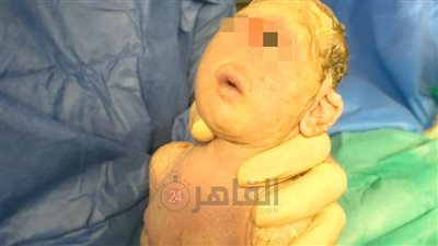 تشوه خلقي نادر.. ولادة طفلة بعين واحدة في مستشفى الغردقة العام | صور