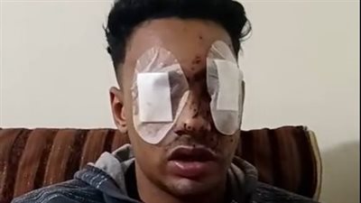 طالب جامعي يفقد عينيه خلال فضه مشاجرة بالمقطم نتيجة رش خرطوش: كنت بدافع عن شاب استنجد بيا| بث مباشر