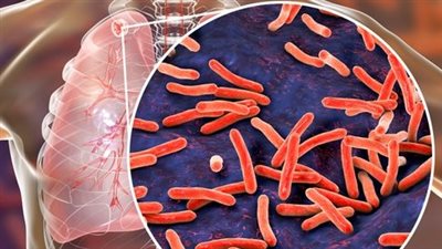 في اليوم العالمي للسل.. تعرف على تأثير الإصابة على الصحة الإنجابية لدى النساء