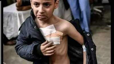 جيل من الأطفال اليتامى.. أطباء بغزة يروون معاناة مصابي الحروق في الحرب