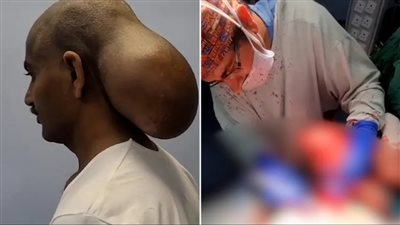 في حجم البطيخة.. إزالة ورم من رأس هندي بعد إلحاق الضرر بجمجمته