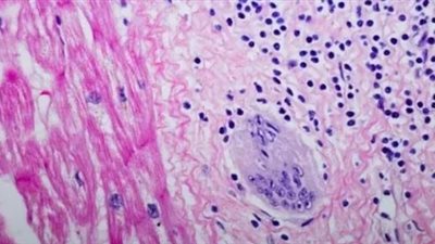 خبراء يتوصلون لاختبار بسيط للكشف عن إصابة الساركويد عن طريق الدم