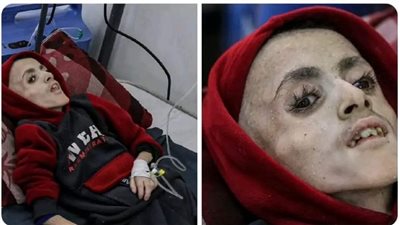 التجويع أبرز أسلحة إسرائيل في غزة.. ماذا يقول القانون الدولي حول استخدامه في الحروب؟