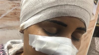 قطعوا أنفها نصفين.. إصابة ربة منزل بإصابات بالغة أثناء دفاعها عن أطفالها بمشاجرة مع جيرانها بشبين القناطر