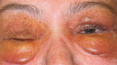 الرعاية الصحية تُعلن عن علاج الداء النشواني بمستشفى النصر ببورسعيد