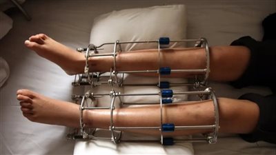 مواطن سعودي حاول إطالة قامته فمات.. ما القصة؟