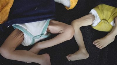 الأونروا: طفل من كل 3 يعاني سوء تغذية.. ومجاعة تلوح في الأفق في غزة