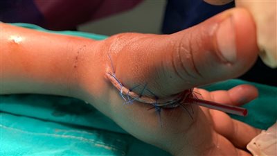 إصابة طفل بجروح عميقة في يده نتيجة لهوه بصاروخ ناري بكفر الشيخ 