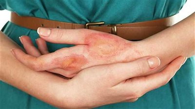 الصحة: 3 أشياء تجنبها إذا تعرضت للحرق أثناء طهي الطعام