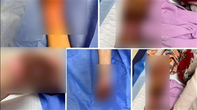 بتلعب كتير.. حبس المتهمة بالاعتداء على ابنتها بمياه مغلية