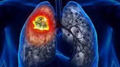 علامة تحذيرية شائعة تظهر عند النوم قد تكون علامة للإصابة بسرطان الرئة | دراسة