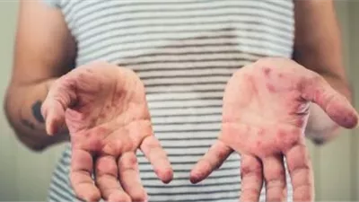 الصحة البرازيلية تعلن 16 ولاية خالية من الحمى القلاعية