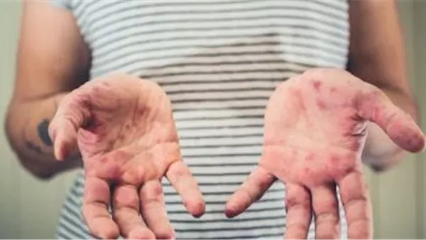 حمى القلاعية 