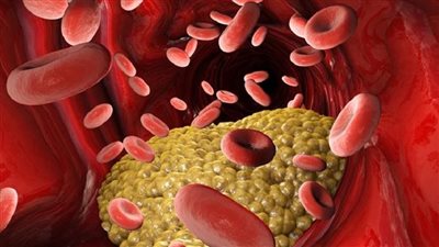  أبرزها ضعف حركة العين.. علامات خطرة على ارتفاع الكوليسترول في الدم 