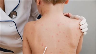 أمريكا تحذر من ارتفاع إصابات مرض المكورات السحائية