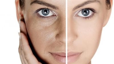 أسباب الإصابة بكلف الوجه.. تعرفي عليها