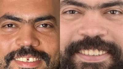 الفنان خالد عليش يشارك مظهر أسنانه الجديد.. والمتابعين: كانت علامة مميزة فيك