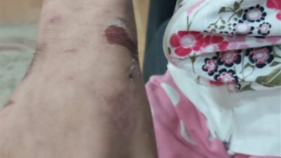 حبس والد الطفلة المتهم بتعذيبها في قليوب وإيداعها إحدى دور الرعاية