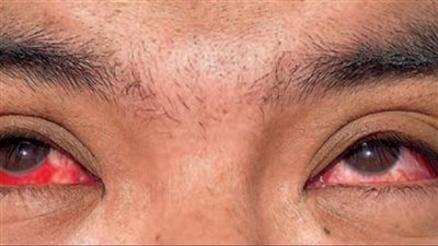 ما هو التهاب الملتحمة بعد ظهوره على أول حالة إصابة بإنفلونزا الطيور؟