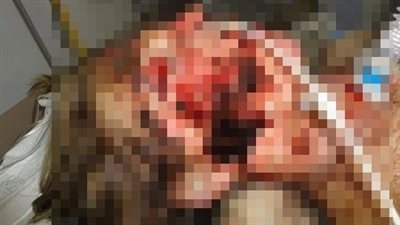 بسبب مسكن الأيبوبروفين.. سيدة يتقشر جلدها وتدخل في غيبوبة 17 يومًا