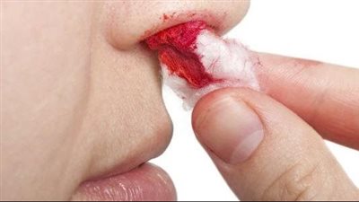 كيفية الوقاية من النزيف في الحر قبل دخول الصيف.. اعرف لصحتك