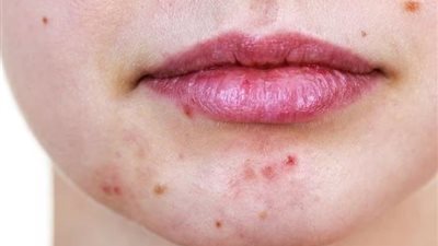 دراسة: اتباع نظام غذائي منخفض السعرات الحرارية يساعد في إزالة حب الشباب