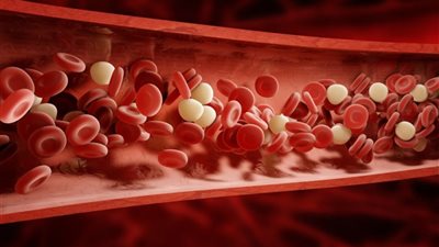 أحد سرطانات الدم.. ما هو الورم النخاعي؟