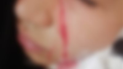 اخد 42 غرزة.. خناقة مدارس تتسبب في إصابة طالب بجرح قطعي بالخصوص