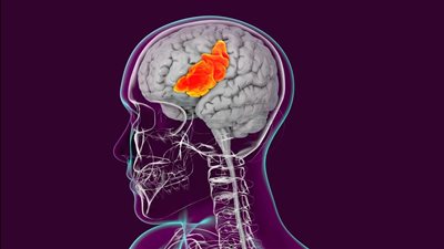 تعمل بالذكاء الاصطناعي ومزوده بشاشة| حكاية شريحة تساعد الناجين من السكتة الدماغية على التواصل باللغتين الإسبانية والإنجليزية