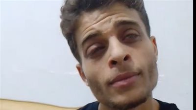 عامل يستغيث من تعرضه لحرق كيميائي أفقده بصره: محتاج زرع قرنية بـ120 ألف جنيه| بث مباشر 