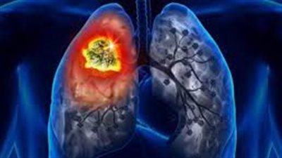 دراسة: غير المدخنين عُرضة للإصابة بسرطان الرئة