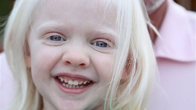 في اليوم العالمي للتوعية بالمهق.. الأمم المتحدة تكشف عن احتمالية إصابة أصحابه بسرطان الجلد