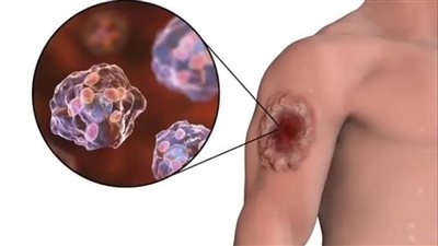 بعد انتشارها في اليابان.. بكتيريا آكلة اللحم النادرة تقضي على الحالات خلال 48 ساعة