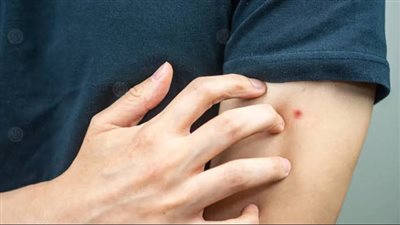 تعرف على أنواع لدغات الحشرات الصيفية ومضاعفاتها الصحية 