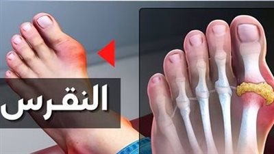 يؤدي إلى تآكل المفاصل.. صحة كفر الشيخ توضح أسباب وطرق علاج مرض النقرس 