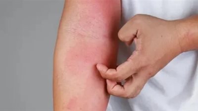 مذيع أمريكي يكتشف إصابته بسرطان الجلد على الهواء مباشرة