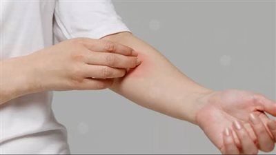 تعرف على مسببات الحساسية الجلدية الشائعة