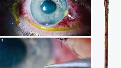 حالة نادرة.. رجل يتعرض لمضاعفات خطيرة بسبب لسعه نحلة في عينه بفيلادلفيا