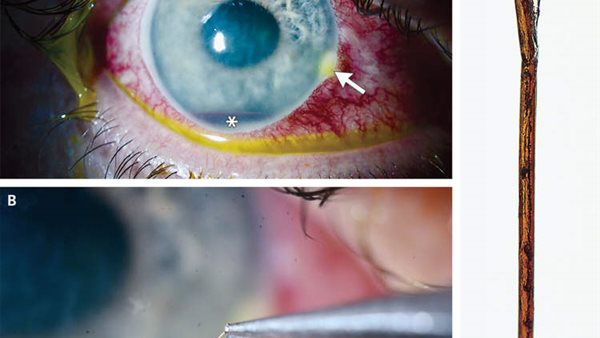 رجل يلسع من نحلة