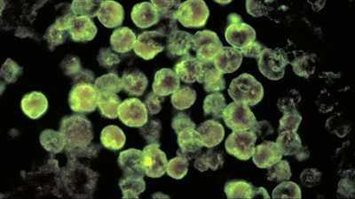 أهمية التشخيص المبكر في علاج مرض التهاب الدماغ السحائي الأميبي