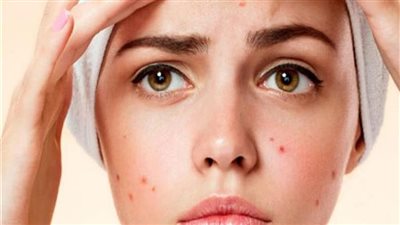 8 نصائح فعالة للتخلص من حب الشباب.. تعرف عليها
