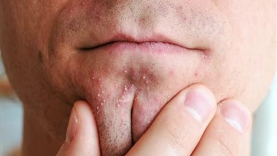 تحذير طبي بسبب عادة خاطئة تخص 80% من الشباب: خطرها يدوم العمر كله 