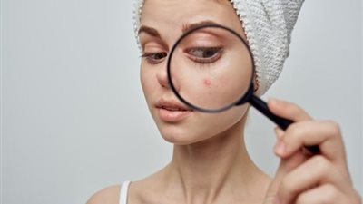 هل روتينك اليومي السبب؟.. إليكِ كيفية منع حب الشباب الناتج عن التوتر