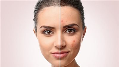 دراسة: منتجات حب الشباب تزيد من خطر الإصابة بالسرطان