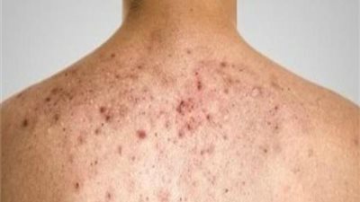تعرف على أبرز طرق الوقاية من حبوب الظهر المزعجة 