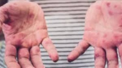 اكتشاف إصابتين بالحصبة داخل ملجأ للمهاجرين في نيويورك